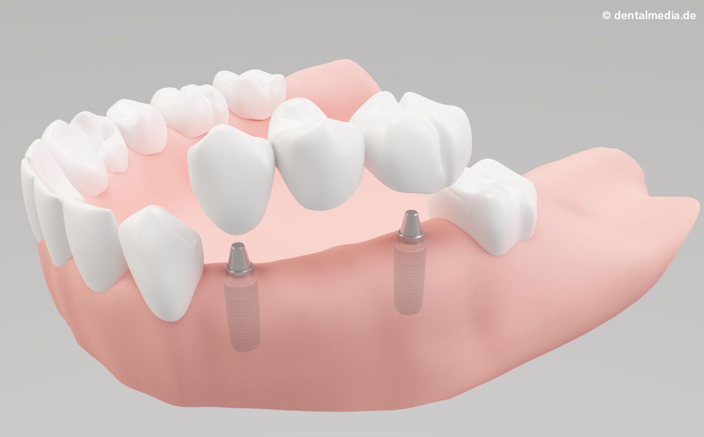 Implantologie : Mehrere Zähne fehlen  Die fehlenden Zähne werden durch Implantate ersetzt, auf die eine Brücke aufgesetzt wird. Nachbarzähne bleiben voll erhalten.