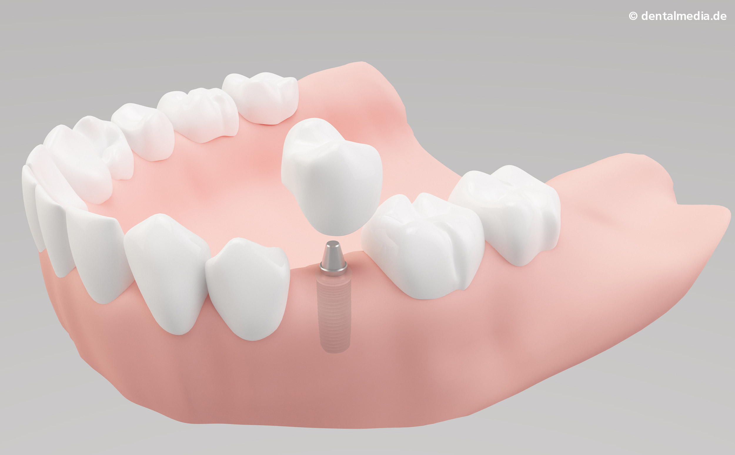 Bonn Implant - Oralchirurgie & Implantologie